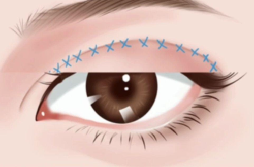 刘珍君做双眼皮怎么样？恢复快不快、线条自然不自然一篇看懂