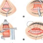 八大处靳小雷和九院苏薇洁谁做双眼皮厉害？2026价格表公布！技术各有千秋