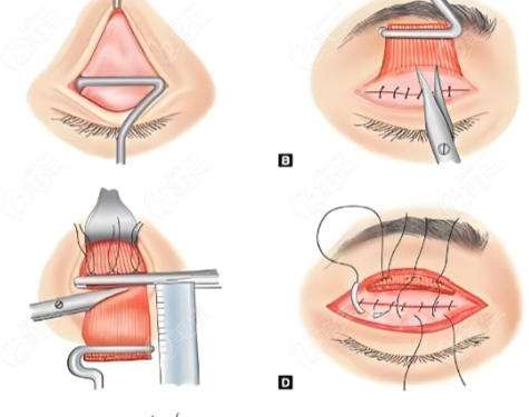 八大处靳小雷和九院苏薇洁谁做双眼皮厉害？2026价格表公布！技术各有千秋