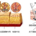 成都军大田其吸脂怎么样？注重形体线条打造\手法轻柔，8千-1.5万元起