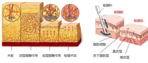 成都军大田其吸脂怎么样？注重形体线条打造\手法轻柔，8千-1.5万元起