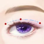 上海苏薇洁修复双眼皮怎么样？九院实力派、眼整形经验丰富/修复案例多！