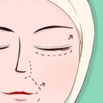 成都宋华敬拉皮怎么样？西区医院技术派、操作细腻_自然不僵硬！