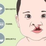 北京八大处王永前唇裂案例一览！2026真实反馈：技术稳、缝合精细！