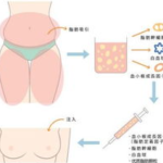 长沙吸脂专家有哪些？医生体型设计风格与价格透明化展示