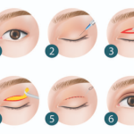 大连牟广隆和李研双眼皮谁做的好？常用术式、线条设计、恢复期表现大盘点