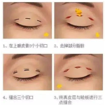 成都谭超医生怎么样？眼修复经验丰富，术后效果自然