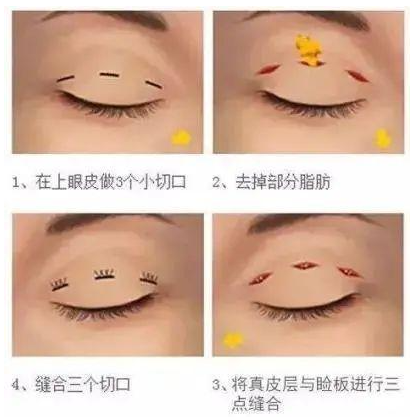 成都谭超医生怎么样？眼修复经验丰富，术后效果自然