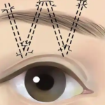 舒茂国做提眉怎么样？手术设计思路、疤痕位置和恢复过程详解