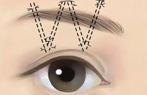 舒茂国做提眉怎么样？手术设计思路、疤痕位置和恢复过程详解