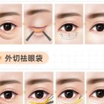 郭时伟的外切眼袋案例图展示！医生经验丰富、风格自然！