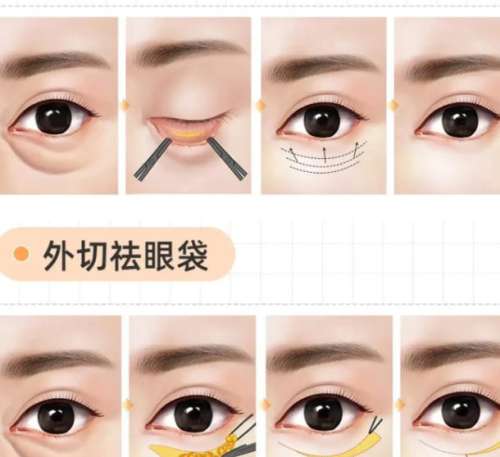郭时伟的外切眼袋案例图展示！医生经验丰富、风格自然！