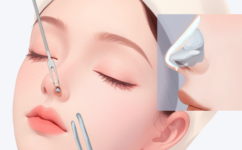 秦晓东做鼻子怎么样？带你看看秦晓东做鼻子的整体风格与典型案例