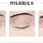 成都王立鹏做双眼皮修复怎么样？技术稳定，修复案例丰富