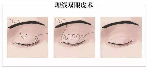 成都王立鹏做双眼皮修复怎么样？技术稳定，修复案例丰富