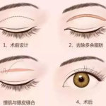 文科医生双眼皮手术如何？技术细腻，术后恢复快