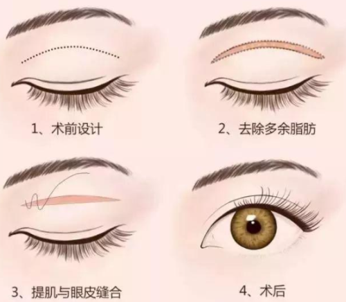 文科医生双眼皮手术如何？技术细腻，术后恢复快