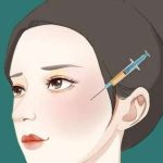 上海孙发明脂肪填充案例参考，技艺娴熟，手法专业