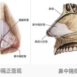 隆鼻技术 | 鼻尖整形中建议取鼻中隔软骨吗？