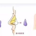这么多种隆鼻材料，要怎么选？