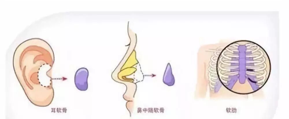 这么多种隆鼻材料，要怎么选？