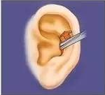 耳软骨、肋软骨、鼻中隔，用它们隆鼻有啥区别？