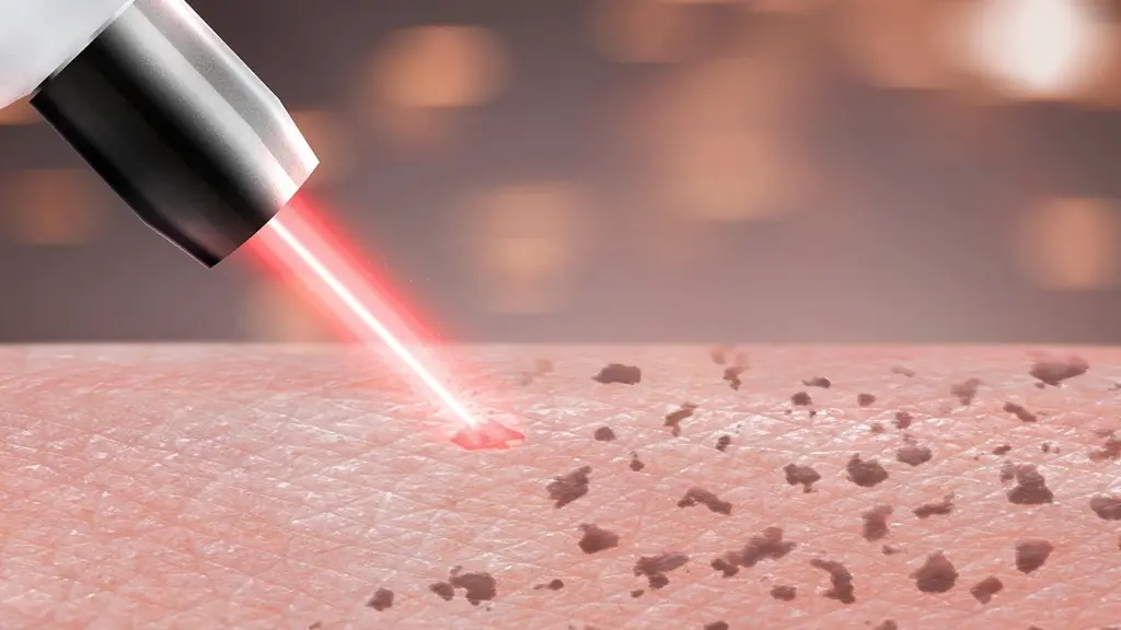 激光祛斑真的有效吗？激光祛斑的四类饮食禁忌