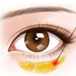 苏州沈国良去眼袋怎么样?技术优势、案例效果与价格区间