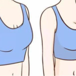 刘春军医生做隆胸怎么样？从术中技术细节到术后胸型稳定度全面分析