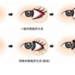 彭千飞双眼皮技术怎样？审美在线，术后效果自然