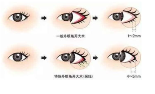 彭千飞双眼皮技术怎样？审美在线，术后效果自然