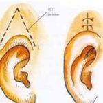 毛小炎耳再造怎么样？技术分析 | 收费价目表2026分析！