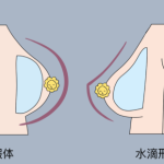 刘中策医生隆胸怎么样？从胸型塑造、上围曲线到疤痕隐蔽度全面评估