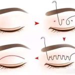 潍坊王少华双眼皮案例_审美与技术测评，风格自然\价格4千元起