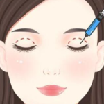 赵兴阳双眼皮案例解析：切口设计、弧度走向、疤痕情况