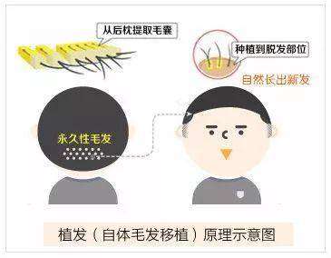 上海九院吴巍植发怎么样？公立三甲毛发移植专家解析，发际线1.5万元起