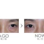 超声法去眼袋多少钱？超声法去眼袋的费用及效果