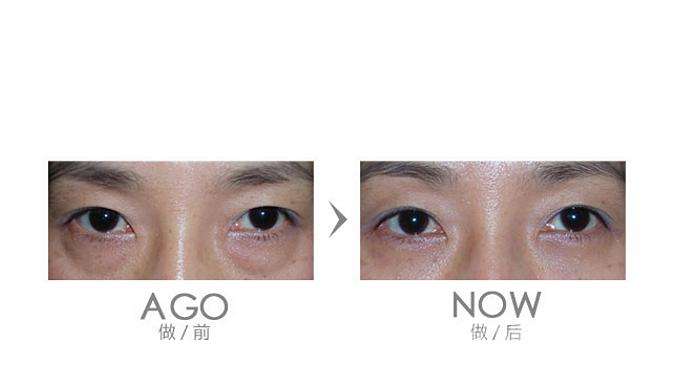 超声法去眼袋多少钱？超声法去眼袋的费用及效果