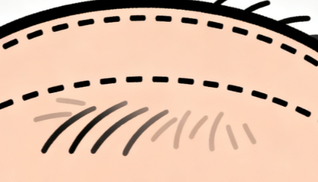 上海植发医生余新明：技术优势、案例展示、预约方式