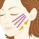 八大处王佳琦的拉皮案例-口碑-2026年价格曝光，2.5万-15万元不等