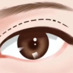 唐毅医生双眼皮技术好吗？切开、埋线、微创各类案例逐一解析