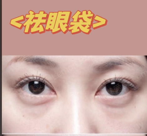 上海去眼袋哪个医生比较好？3位靠谱去眼袋医生实测，不同需求对应选