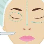 北京房嘉宾双眼皮修复怎么样？三甲背景医生技术_价格真相揭晓(眼修复必看)