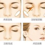 上海张余光苹果肌复位手术_九院主任技术详解，价格2.8万元起(抗衰必看)