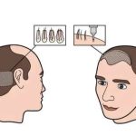 潍坊医学院附属医院植发医师有谁？牛常英领衔/fue技术_价格亲民！