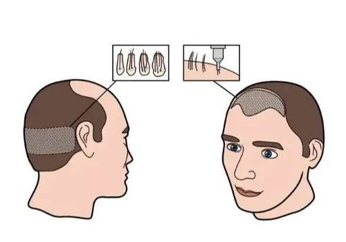 潍坊医学院附属医院植发医师有谁？牛常英领衔/fue技术_价格亲民！