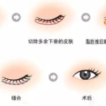 成都黄元利医生口碑怎么样？双眼皮术后自然，价格实惠