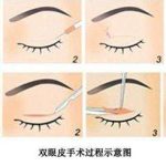 东莞刘玉生双眼皮案例 | 清新自然款和眼修复案例反馈 | 价格表