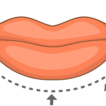 潘柏林医生唇部手术案例：从术前设计到术后恢复，全流程细节解析