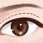 北京赵红艺做双眼皮好吗？定制化方案_造型自然、放心选择！